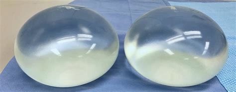 3000cc breast implant gallery.